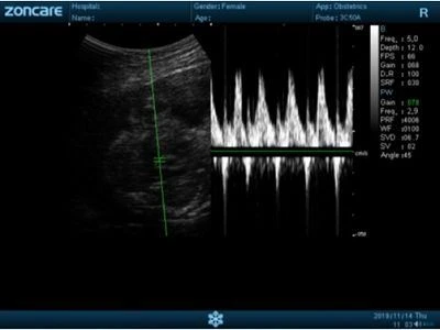 Fetal Heart - PW(001)