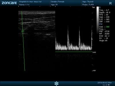 Vertebral Artery - PW(001)