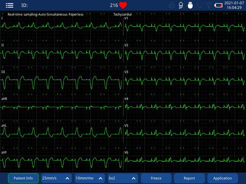 product-1-1 12 channel electrocardiograph machine with printer