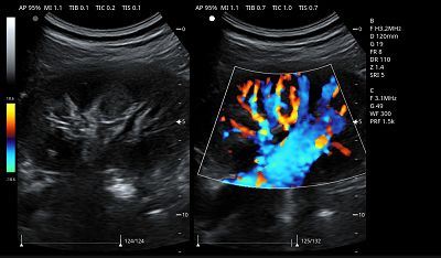Kidney B &C Mode 1(001)