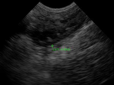 Left kidney Left kidney